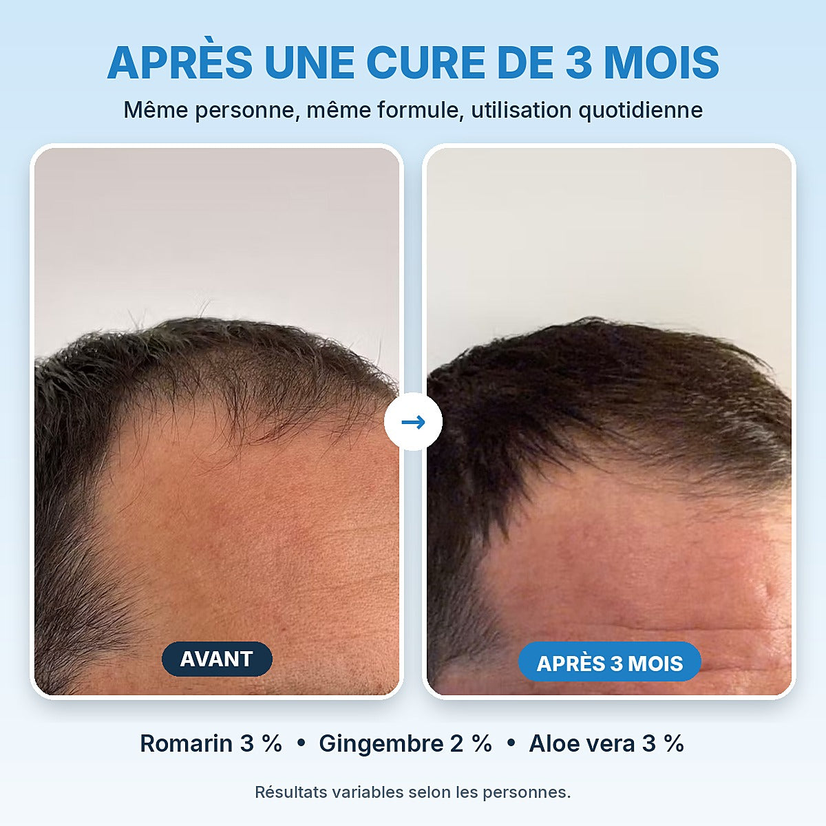 Cure anti-chute 3 mois : pourquoi cette durée et comment la réussir